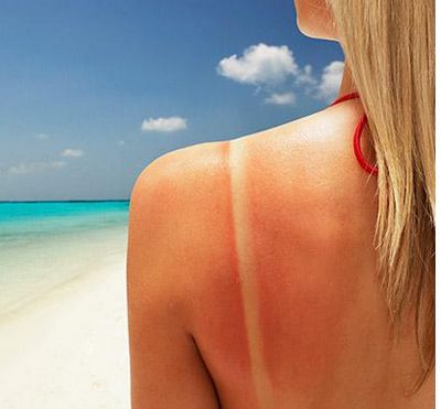 晒伤后如何补救？