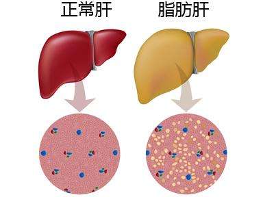 轻度脂肪肝不只是富贵病而已