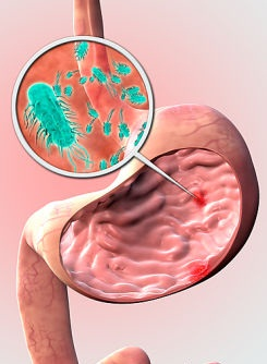 感染幽门螺旋杆菌≠会得胃癌