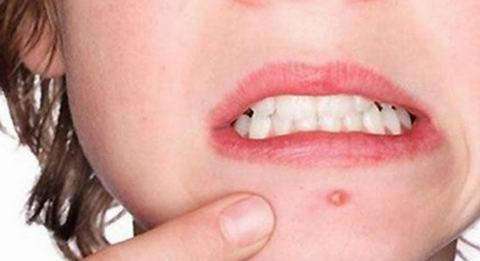 你以为脸上长“痘”只是逗你玩吗