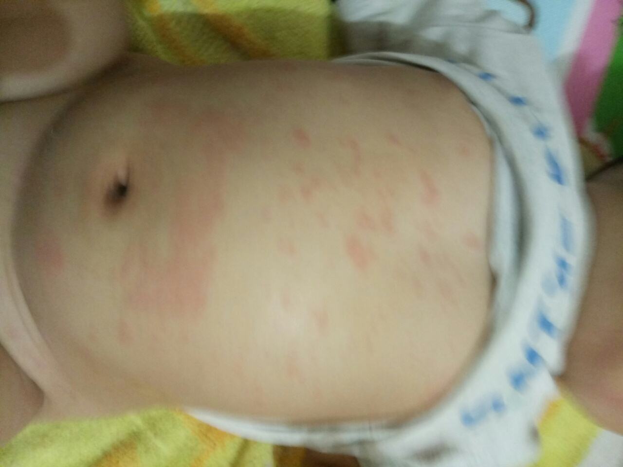过敏红斑.jpg