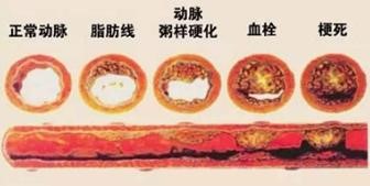 猝死2.jpg