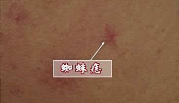 有蜘蛛痣就一定是肝硬化吗？